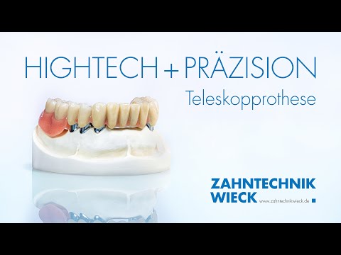 Digitale Fertigung der Teleskopprothese | Zahntechnik Wieck