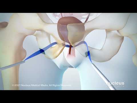 Urinary Incontinence: Transobturator Tape (TOT) Procedure