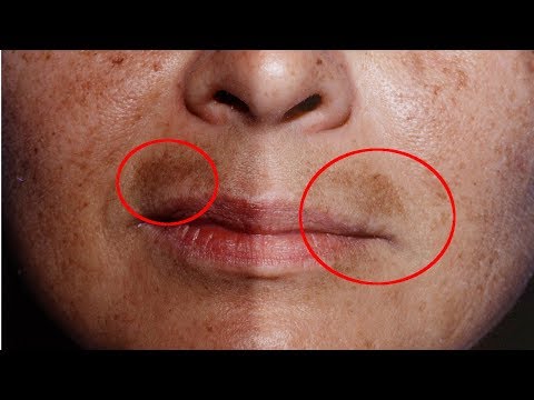 Рецепты с бодягой от пигментных пятен Веснушки фото ребенка