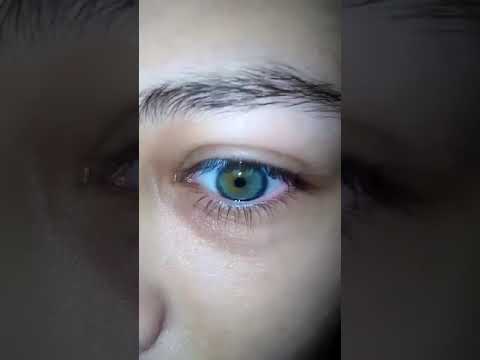 Voluntary nystagmus