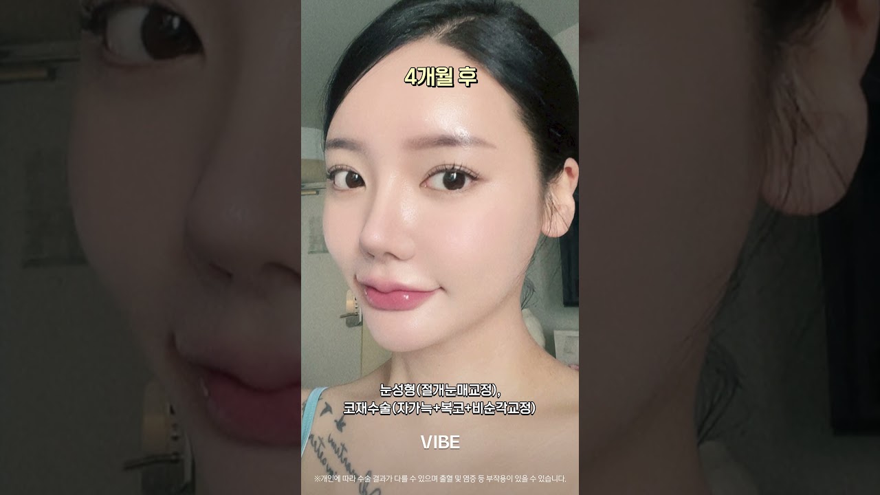 눈성형(절개눈매교정), 코재수술(자가늑+복코+비순각교정)