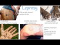 Leprosy signs and symptoms, Treatment.  (Hansen's Disease)