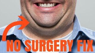 CHIN FAT REDUCTION - without surgery
