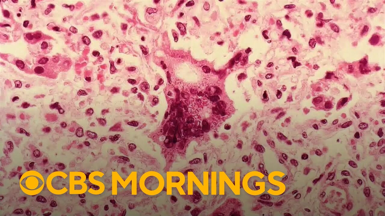 Measles cases climb to nearly 60 at university in Florida as outbreaks surge across U.S.