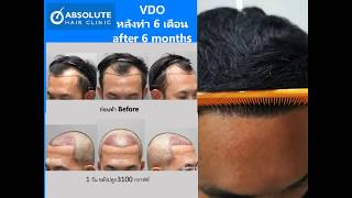 ปลูกผมแบบเจาะ FUE 3100 กราฟท์ ผล 6 เดือนหลังทำ FUE hair transplantation Absolute Hair Clinic