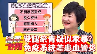 雙腿瘀青疑似家暴？竟是免疫系統差患「血管炎」？！【#醫師好辣】20221122 part1 EP1453 洪永祥 蔡逸姍