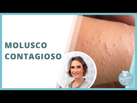 MOLUSCO CONTAGIOSO – O QUE É, SINTOMAS, TRATAMENTO | MACETES DE MÃE