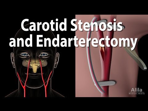 Carotid Stenosis and Carotid Endarterectomy, Animation