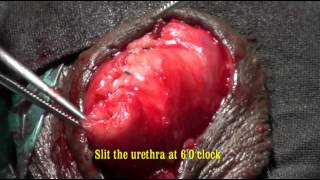 Partial penectomy