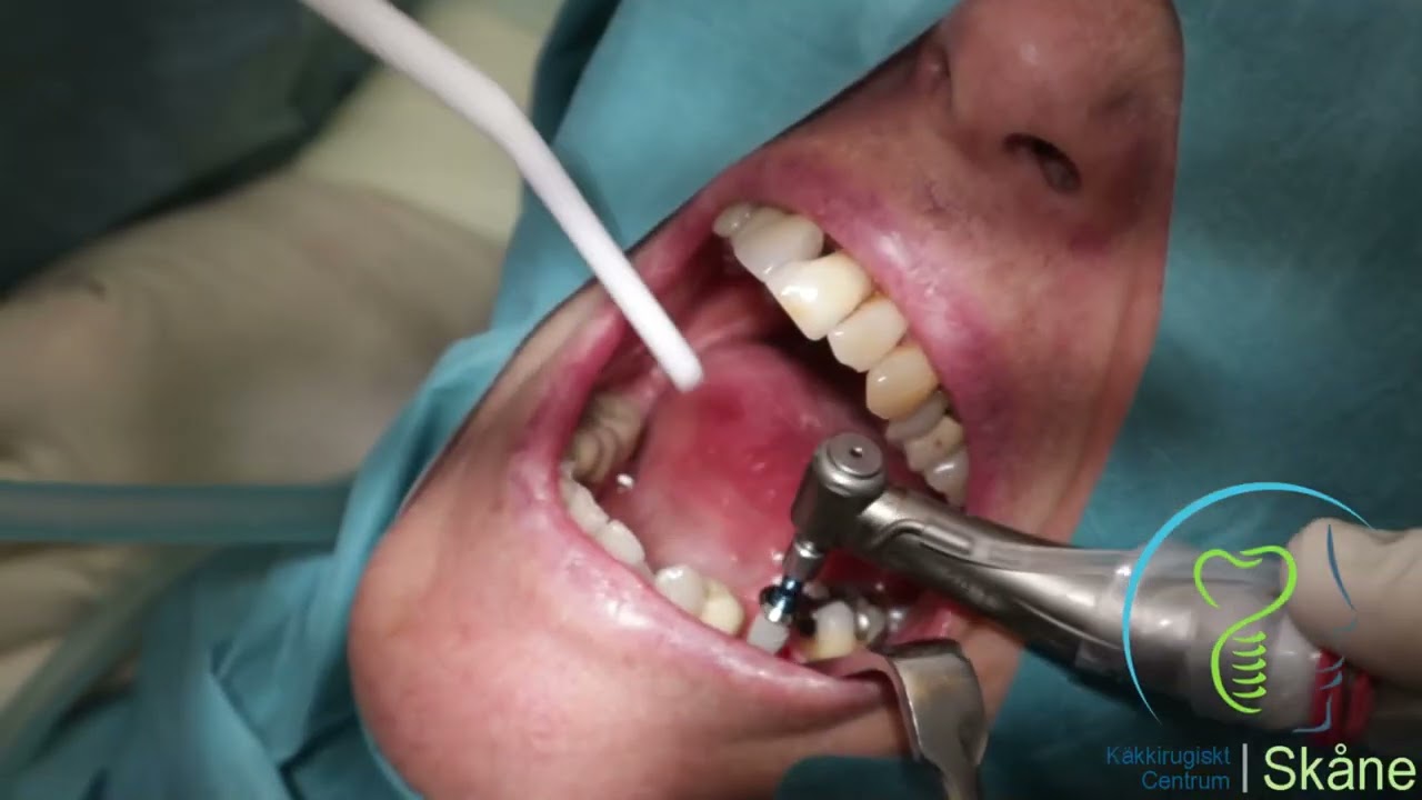 Dental Implant  surgery