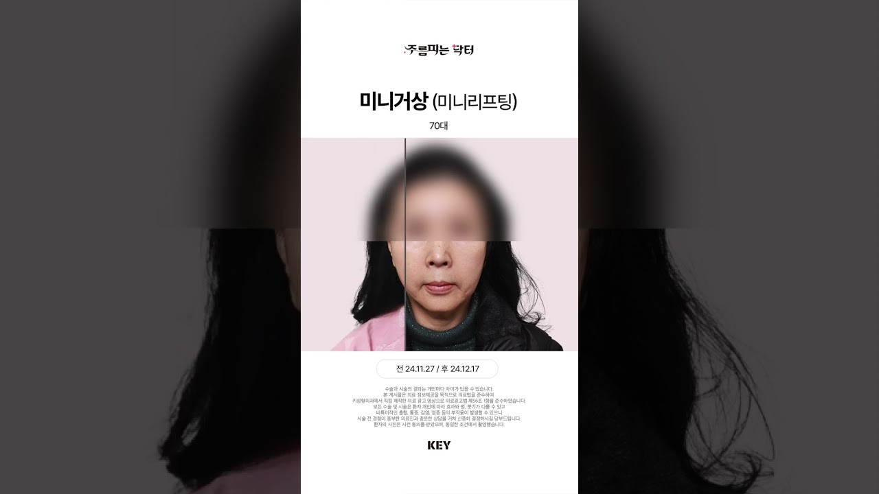 70대의 미니거상 미니리프팅 대구키성형외과