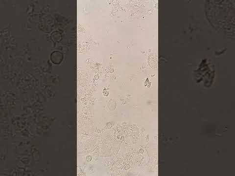 Trichomonas vaginalis in the urine #laboratory #mls #medtechstudent #microscope #microbiology #cls