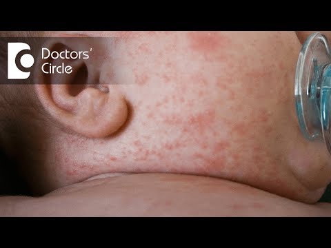 What causes Prickly Heat Rash? - Dr. Rajdeep Mysore