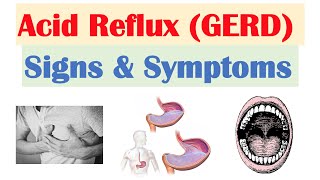 Gastroesophageal Reflux Disease (GERD) Signs & Symptoms (ex. Bad Teeth) | & Why They Occur