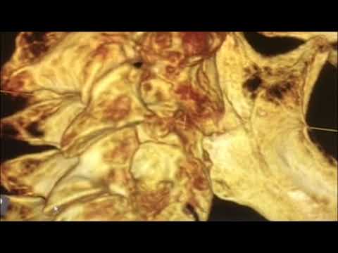 Dr Drew explains posterior lower cervical misalignments