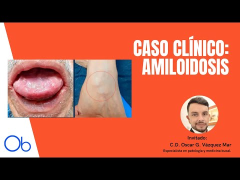 CASO CLÍNICO: Amiloidosis 👅