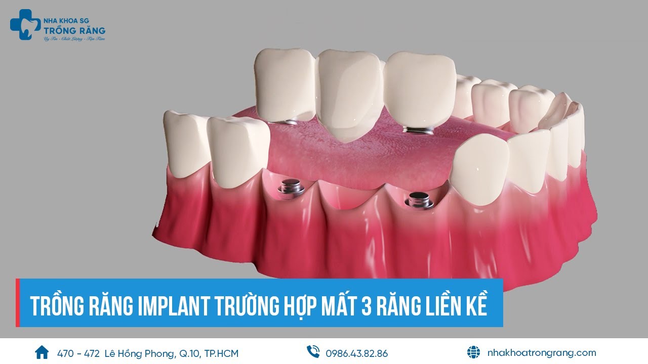 Trồng răng implant cho 3 răng hàm liền kề