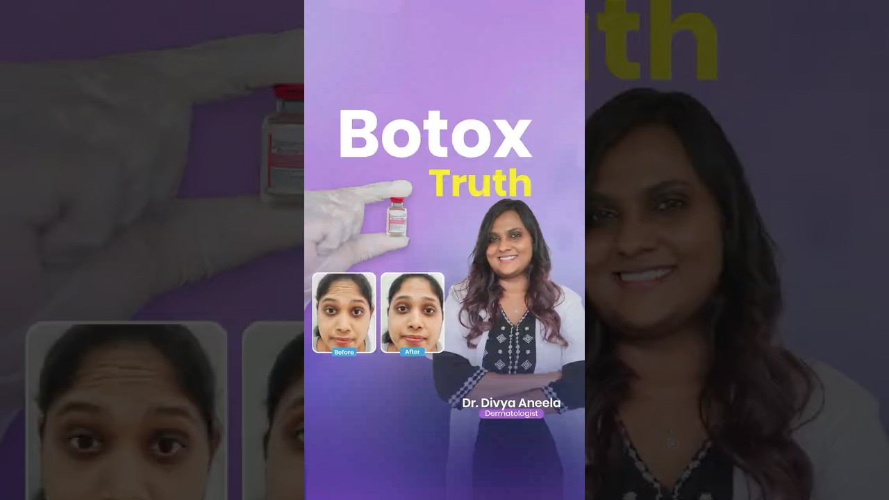 THE TRUTH ABOUT BOTOX – DERMATOLOGIST EXPLAINS! #botox #antiaging
