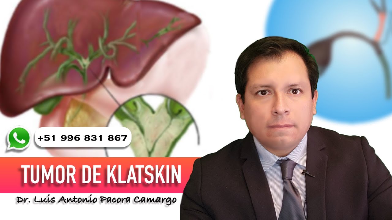 TUMOR DE VÍAS BILIARES: TUMOR DE KLATSKIN, EL CÁNCER DE LA CONFLUENCIA DE LAS VÍAS BILIARES ⚠