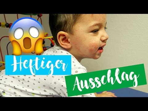 Der Kefir von der Schuppenflechte Auf den Händen des Ekzems