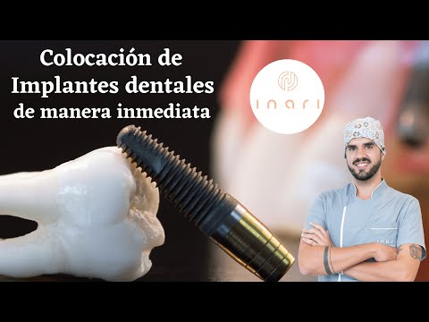 Implantes de manera inmediata