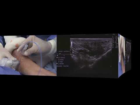 VenaCure Pvak : perforator and accessory vein ablation kit - Société Française de Phlébologie