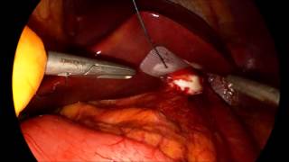 VERSA LIFTER BAND@ Gastric Band retrieval Dr. Malherbe, France