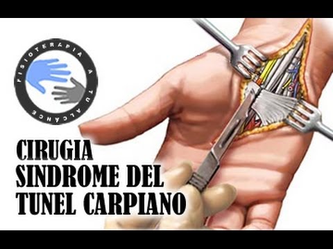 Operacion del tunel carpiano
