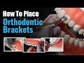 How to place Orthodontic Brackets | Waldent Metal Bracket Kit MBT 022 Slot