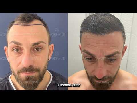 Hair Transplant Turkey Result |  Before and After  | 7 months step by step