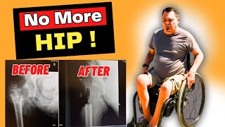 Pressure Sores Turned Into a Nightmare! Girdle Stone Procedure Explained