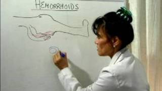 How to Cure Hemorrhoids : What Causes Hemorrhoids?