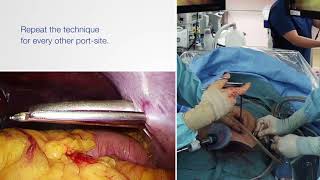 Usage of the Mediflex Suture Grasper Family