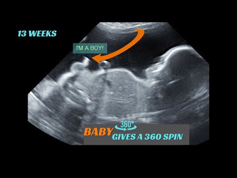 13 weeks | Baby boy | does 360 spin in womb | Ultrasound