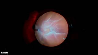 REPAIRING A TOXOPLASMOSIS RELATED RETINAL DETACHMENT WITH EXTERNAL NEEDLE DRAINAGE