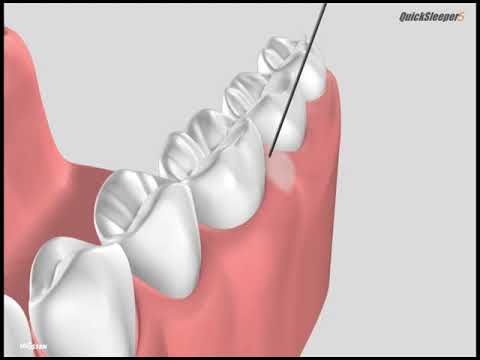 How to use the Quicksleeper?