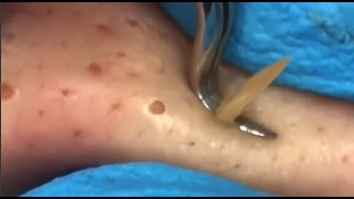 Blackhead Squeezed Pimple Removal