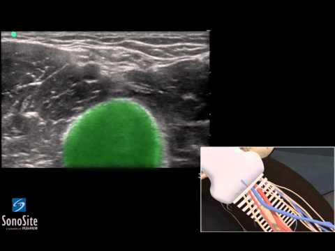 3D Lehrvideo: Ultraschallgestützes peripheres Legen von Venen Katheter -  SonoSite Ultraschall