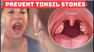 What CAUSES Tonsil Stones and How to Prevent Them