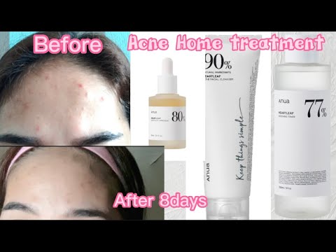 8days JOURNEY ON HEALING MY ACNE/ PIMPLE using ANUA HEARTLEAF K-Beauty products