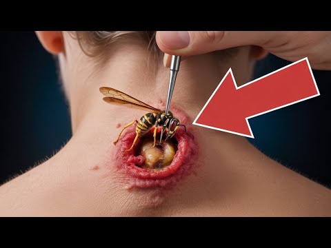 A Mom Ignored a Pimple on Her Son’s Neck—Until It Grew, and What Happened Next Was Truly Shocking!