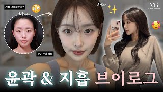 윤곽 3종&지방 흡입 솔직후기 성형VLOG✨ I 성형후기 I VLOG I 안면윤곽 I 복부지흡 I