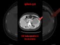 spleen cyst CT picture