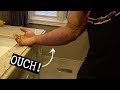 Bicep tear : it looks pretty messed up now!