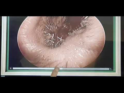 Vestibular papillomatosis treatment uk