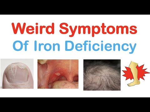 Weird Symptoms of Iron Deficiency | Nails, Tongue, Skin, Hair & Others