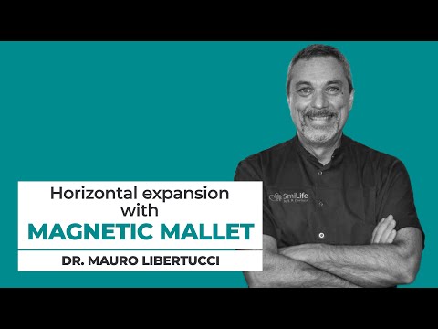 Dr. M. Libertucci — split crest and sinus lift simultaneous with Magnetic Mallet