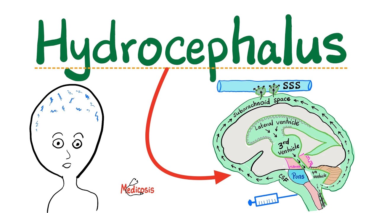 Hydrocephalus -Communicating, Noncommunicating Hydrocephalus,Normal Pressure Hydrocephalus,Ex vaccuo