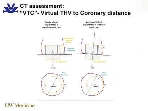 Valve in Valve TAVR; Predicting When the Coronaries are at Risk