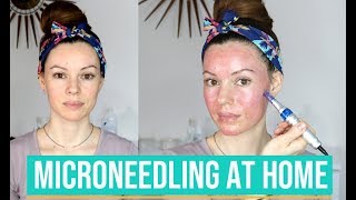How I Microneedle at Home with Dr. Pen - Demo & Tips
